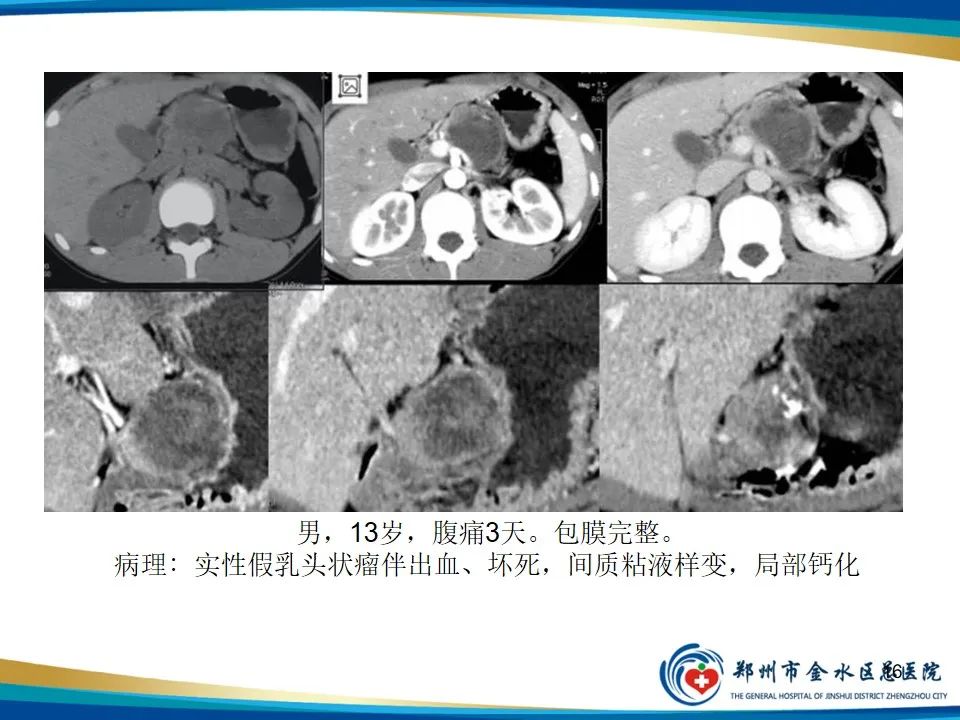 影像PPT - 【PPT】胰腺实性假乳头状瘤影像学表现-16