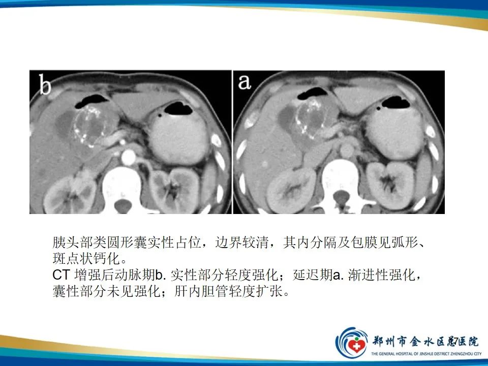 影像PPT - 【PPT】胰腺实性假乳头状瘤影像学表现-17