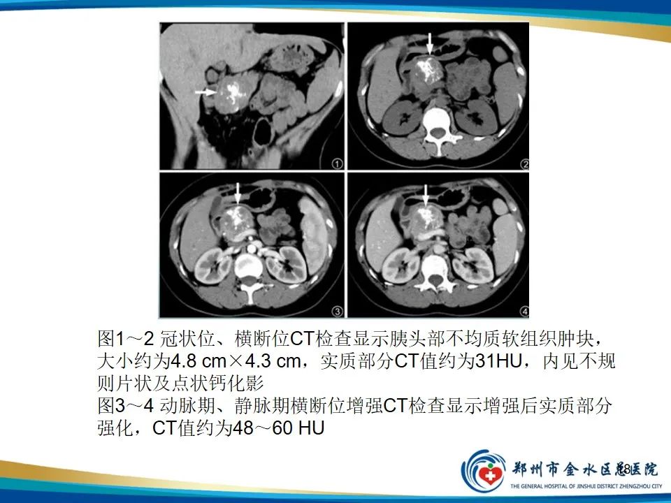 影像PPT - 【PPT】胰腺实性假乳头状瘤影像学表现-18
