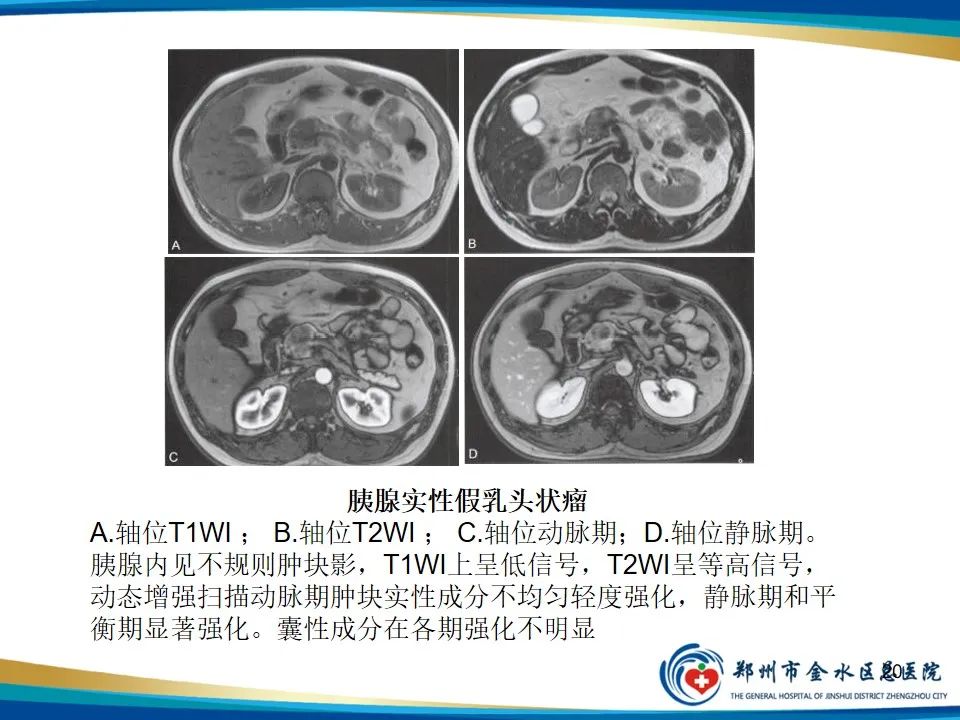 影像PPT - 【PPT】胰腺实性假乳头状瘤影像学表现-20