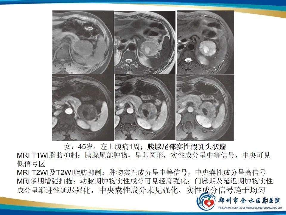 影像PPT - 【PPT】胰腺实性假乳头状瘤影像学表现-21