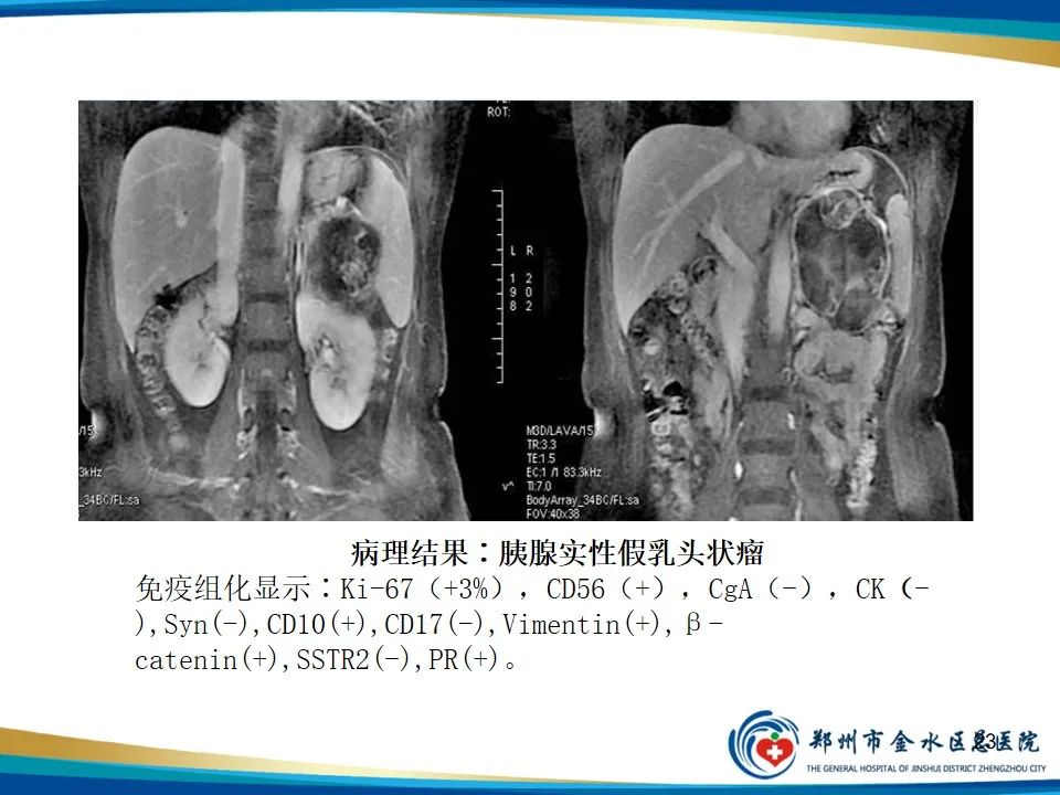 影像PPT - 【PPT】胰腺实性假乳头状瘤影像学表现-23