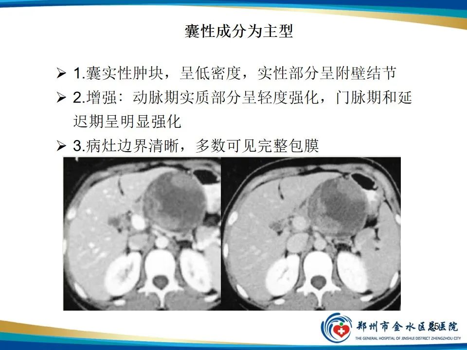 影像PPT - 【PPT】胰腺实性假乳头状瘤影像学表现-25