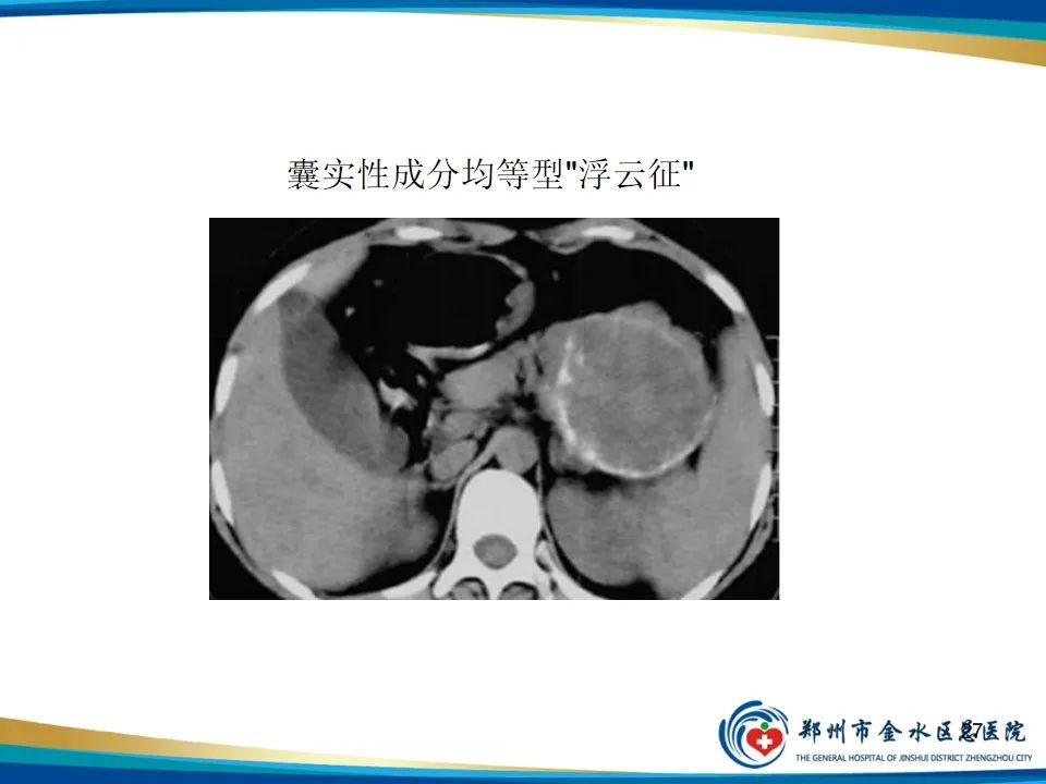 影像PPT - 【PPT】胰腺实性假乳头状瘤影像学表现-27
