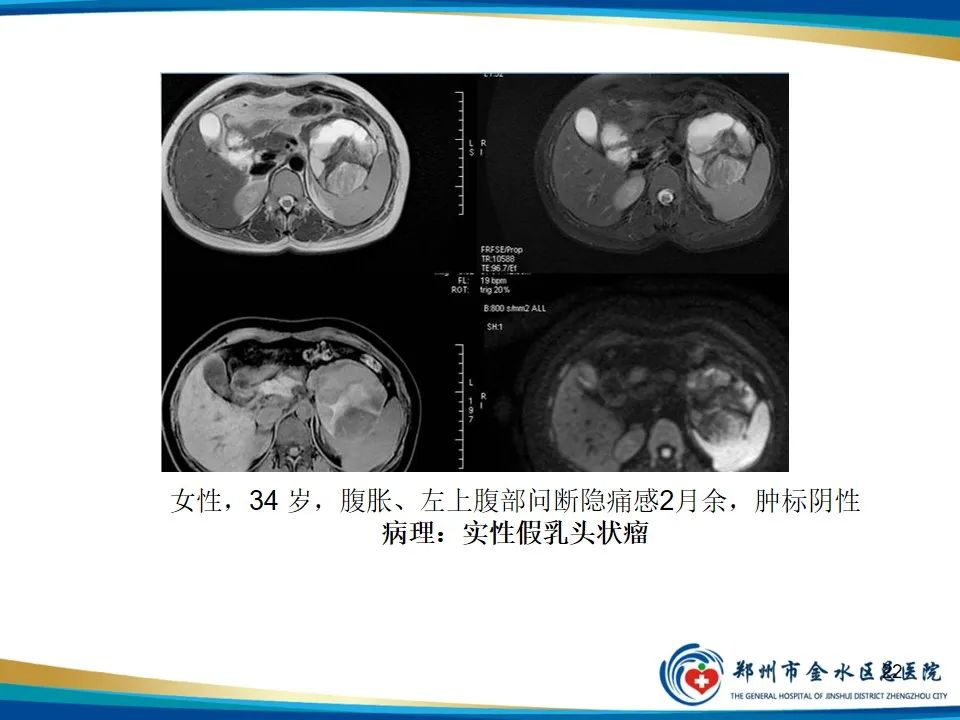 影像PPT - 【PPT】胰腺实性假乳头状瘤影像学表现-22