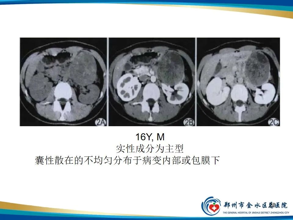 影像PPT - 【PPT】胰腺实性假乳头状瘤影像学表现-28