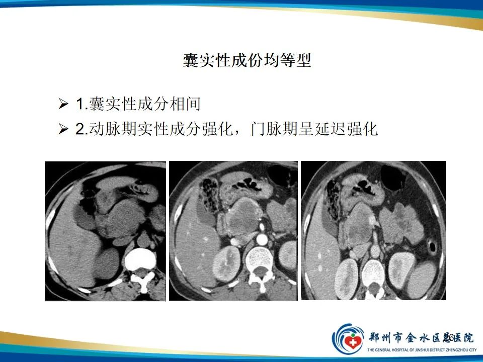 影像PPT - 【PPT】胰腺实性假乳头状瘤影像学表现-26