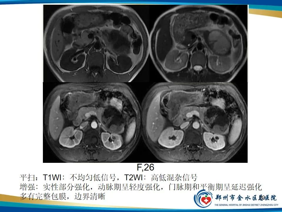 影像PPT - 【PPT】胰腺实性假乳头状瘤影像学表现-29