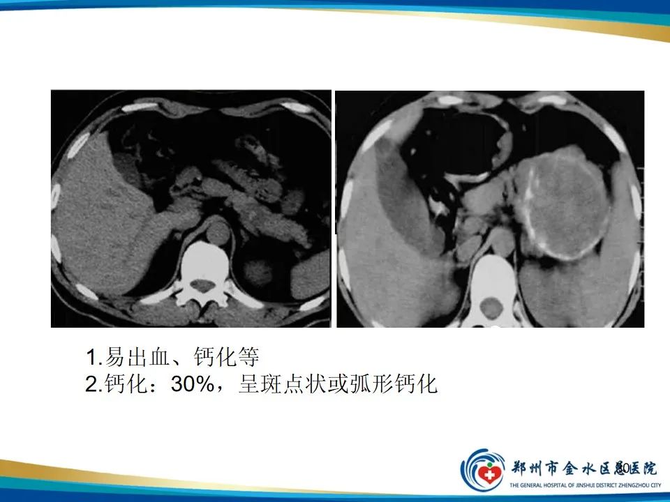 影像PPT - 【PPT】胰腺实性假乳头状瘤影像学表现-30