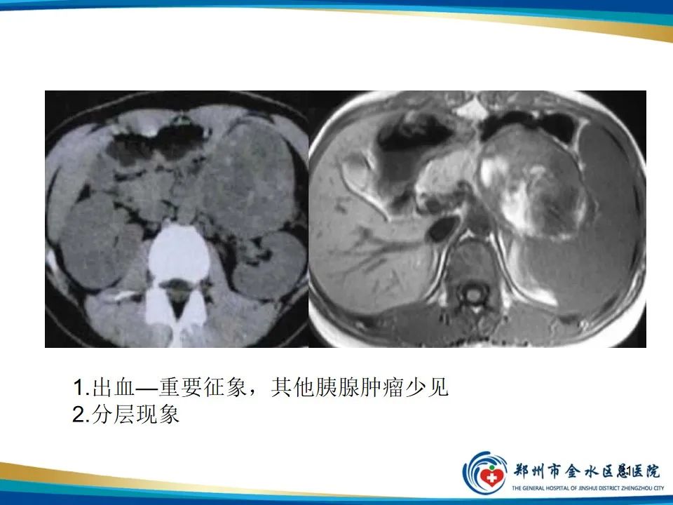 影像PPT - 【PPT】胰腺实性假乳头状瘤影像学表现-31