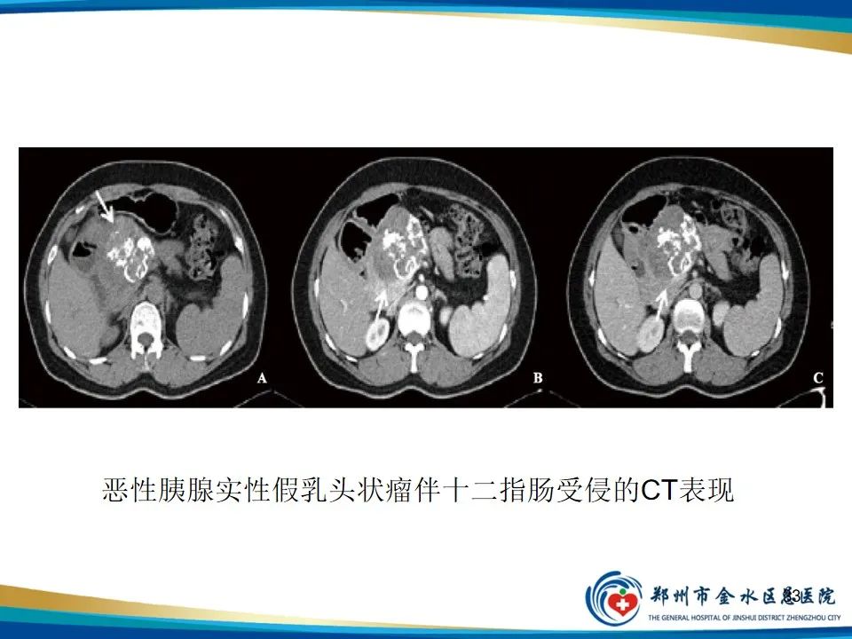 影像PPT - 【PPT】胰腺实性假乳头状瘤影像学表现-33