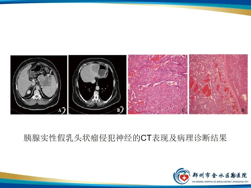 影像PPT - 【PPT】胰腺实性假乳头状瘤影像学表现-34
