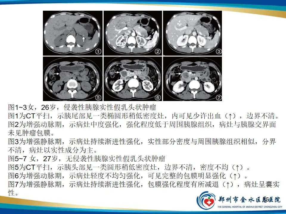 影像PPT - 【PPT】胰腺实性假乳头状瘤影像学表现-35
