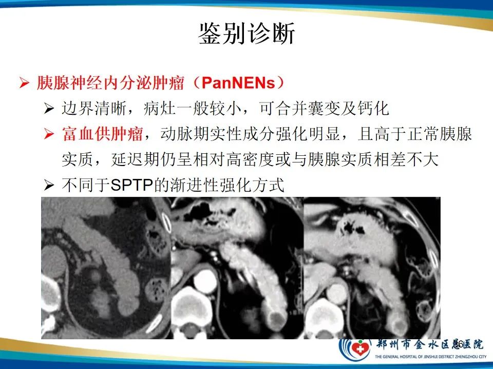 影像PPT - 【PPT】胰腺实性假乳头状瘤影像学表现-36