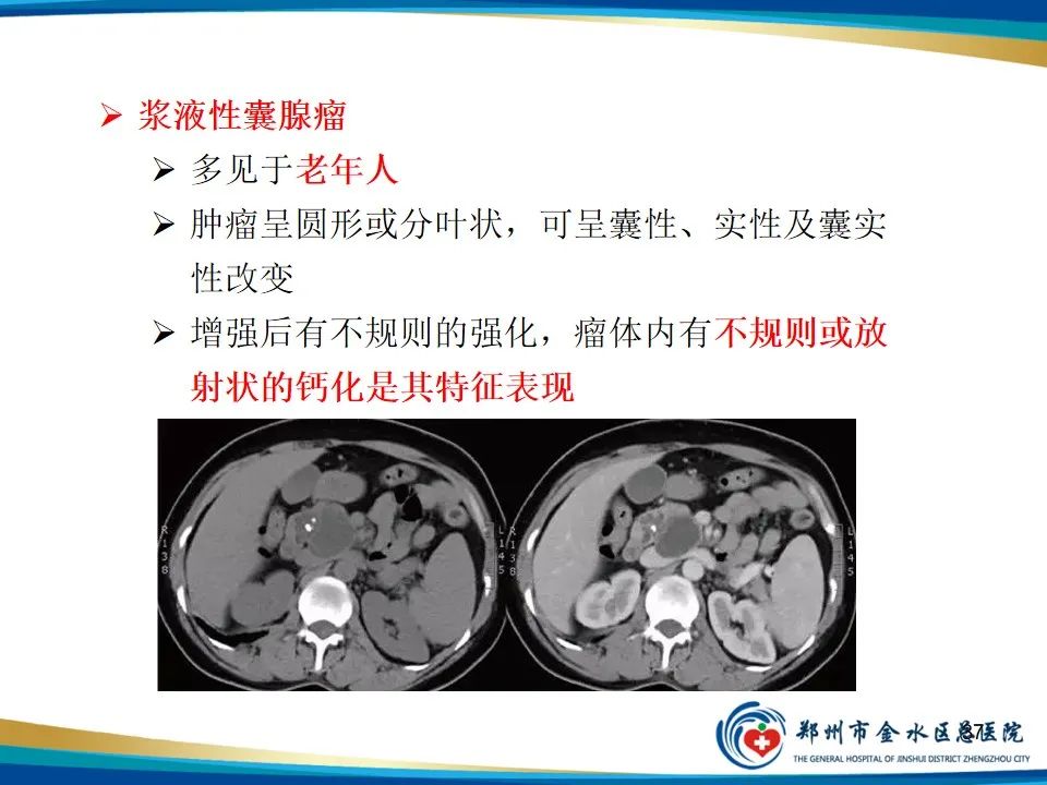 影像PPT - 【PPT】胰腺实性假乳头状瘤影像学表现-37