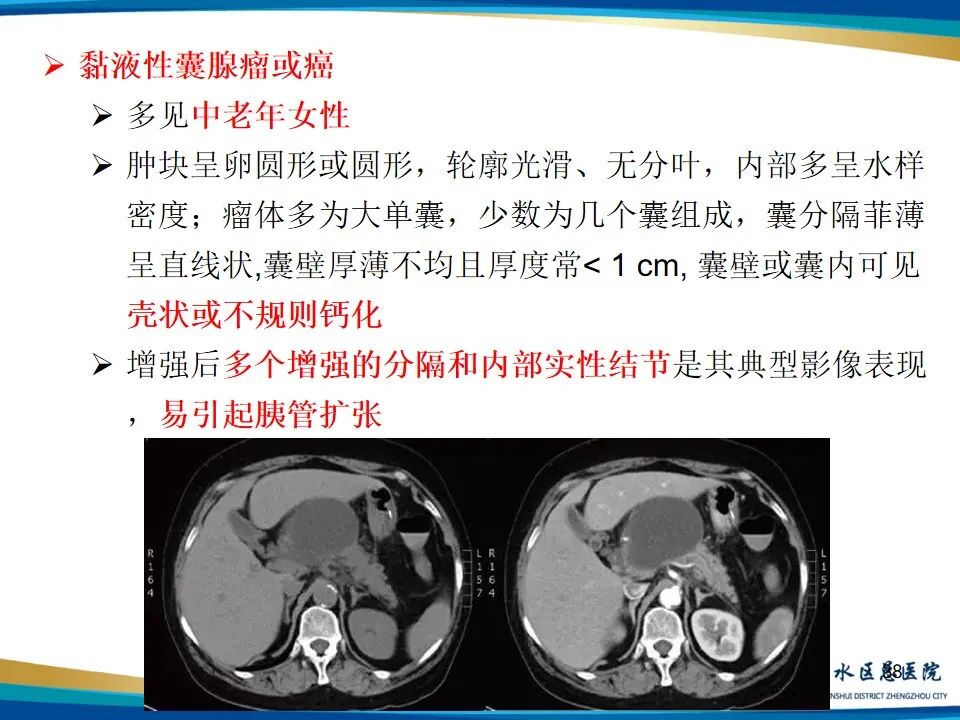 影像PPT - 【PPT】胰腺实性假乳头状瘤影像学表现-38