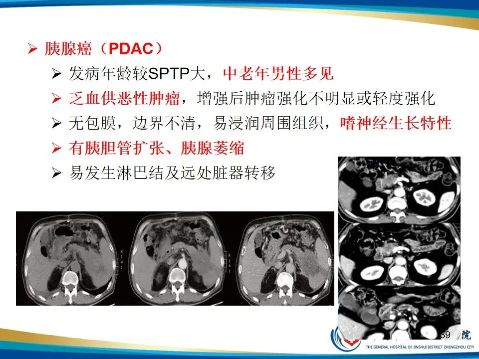 影像PPT - 【PPT】胰腺实性假乳头状瘤影像学表现-39
