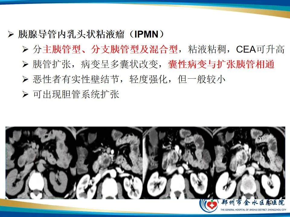 影像PPT - 【PPT】胰腺实性假乳头状瘤影像学表现-40