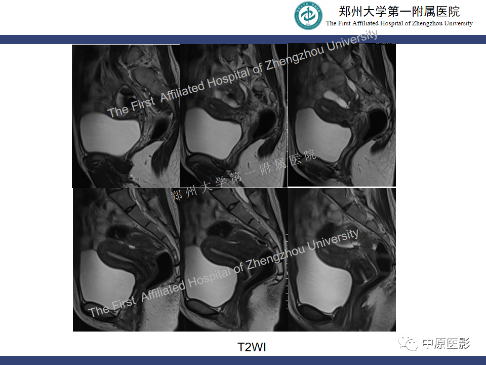 影像PPT - 【病例】直肠子宫内膜异位症1例MR影像-3