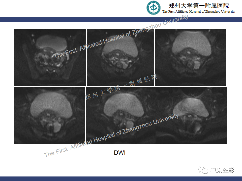 影像PPT - 【病例】直肠子宫内膜异位症1例MR影像-7