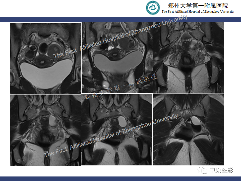 影像PPT - 【病例】直肠子宫内膜异位症1例MR影像-6