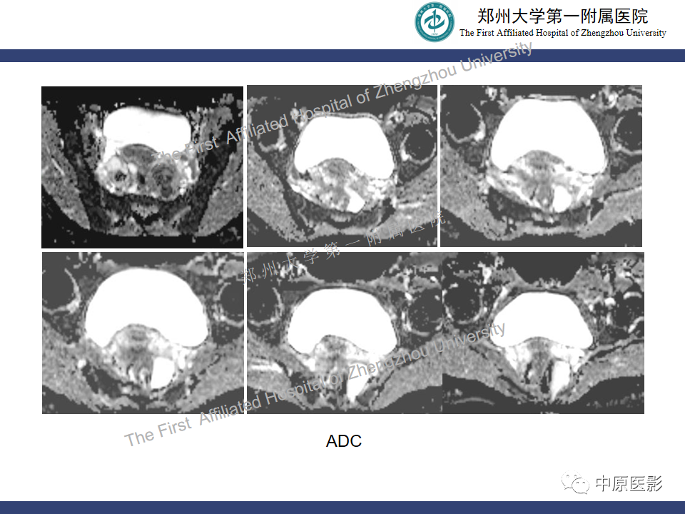 影像PPT - 【病例】直肠子宫内膜异位症1例MR影像-8