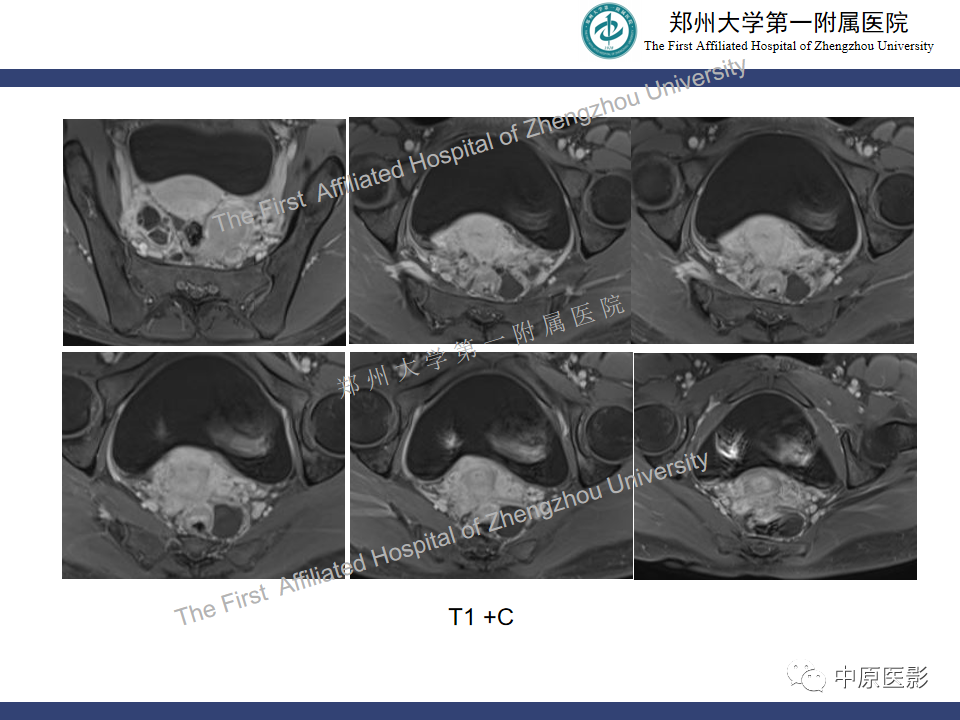 影像PPT - 【病例】直肠子宫内膜异位症1例MR影像-9