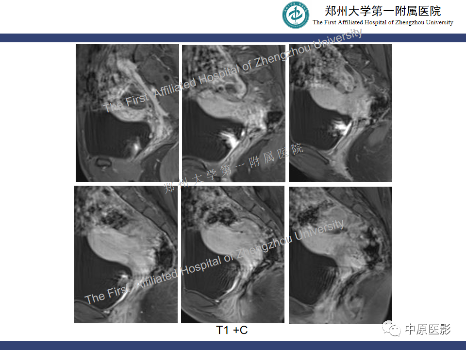 影像PPT - 【病例】直肠子宫内膜异位症1例MR影像-10