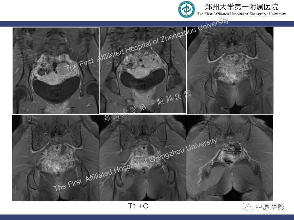 影像PPT - 【病例】直肠子宫内膜异位症1例MR影像-11