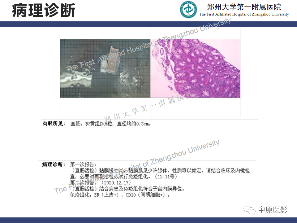 影像PPT - 【病例】直肠子宫内膜异位症1例MR影像-13