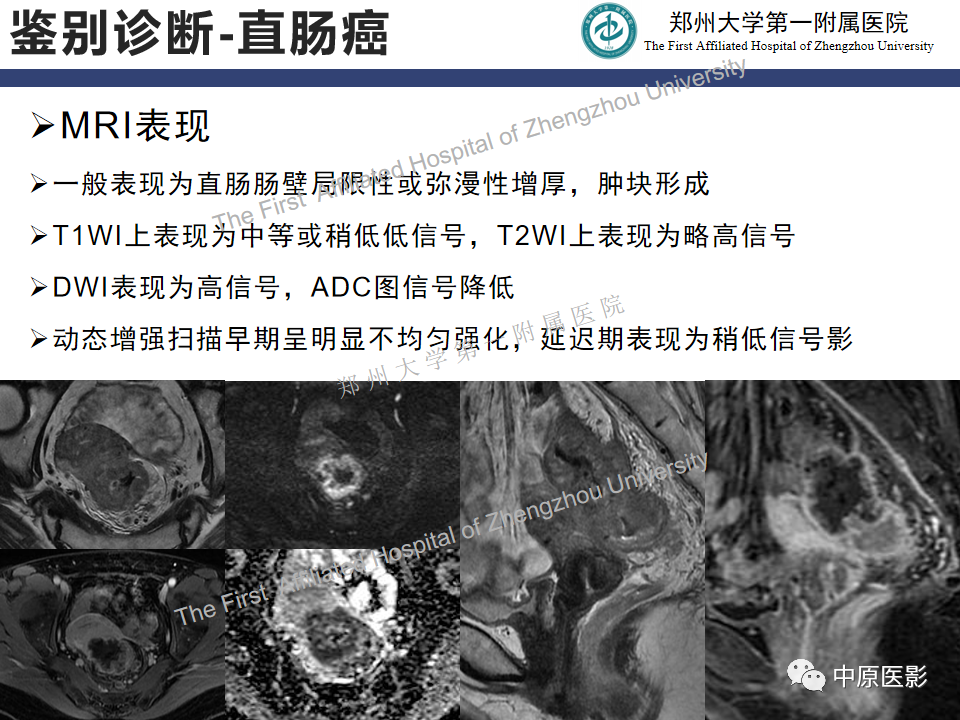 影像PPT - 【病例】直肠子宫内膜异位症1例MR影像-17
