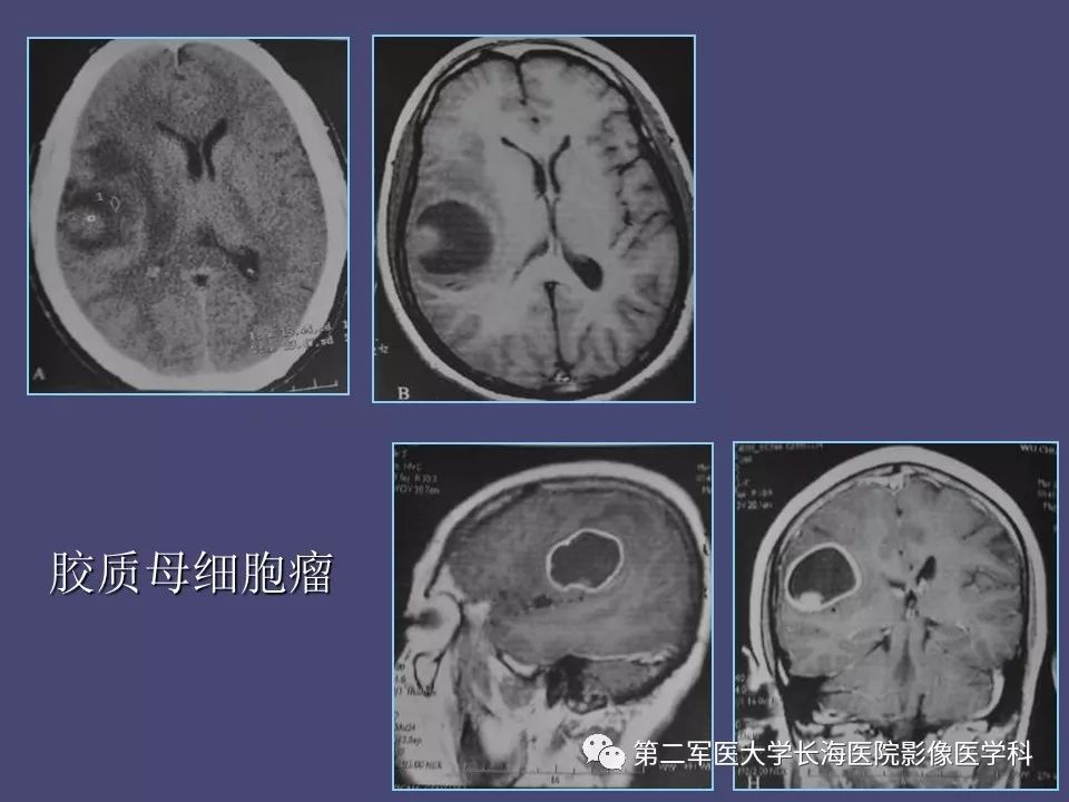 影像PPT - 【PPT】脑内常见环形强化病变的鉴别诊断-7