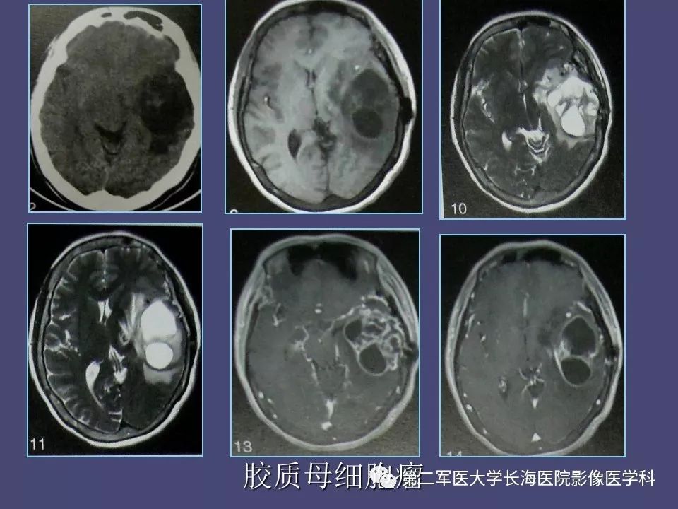 影像PPT - 【PPT】脑内常见环形强化病变的鉴别诊断-8