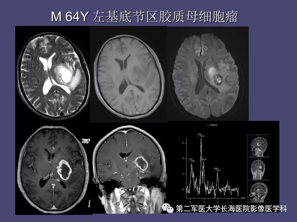 影像PPT - 【PPT】脑内常见环形强化病变的鉴别诊断-6