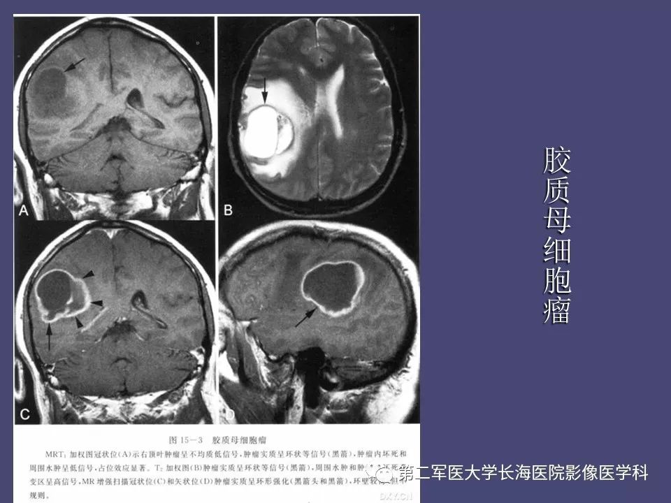 影像PPT - 【PPT】脑内常见环形强化病变的鉴别诊断-9