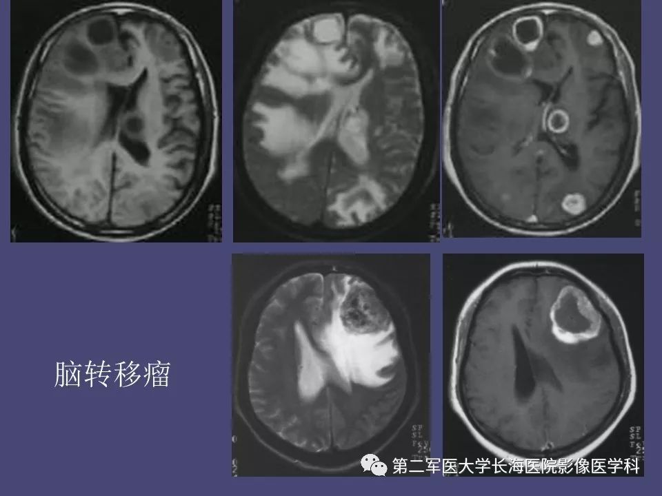 影像PPT - 【PPT】脑内常见环形强化病变的鉴别诊断-15