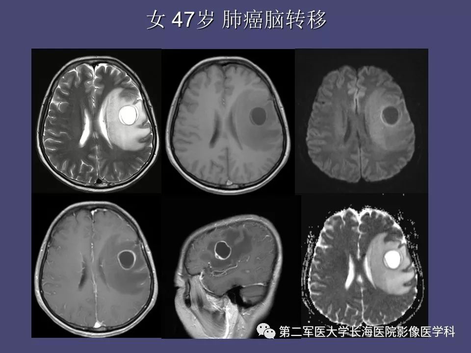 影像PPT - 【PPT】脑内常见环形强化病变的鉴别诊断-16