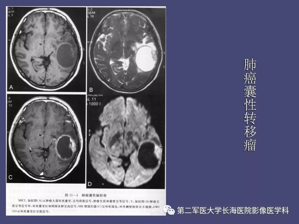 影像PPT - 【PPT】脑内常见环形强化病变的鉴别诊断-18
