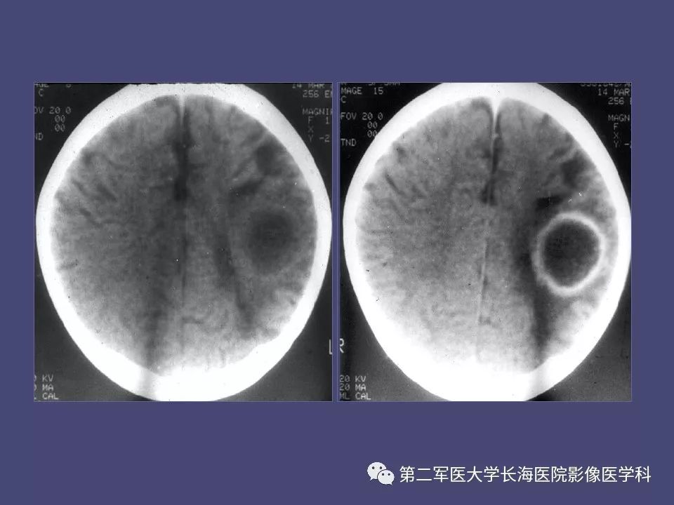 影像PPT - 【PPT】脑内常见环形强化病变的鉴别诊断-24