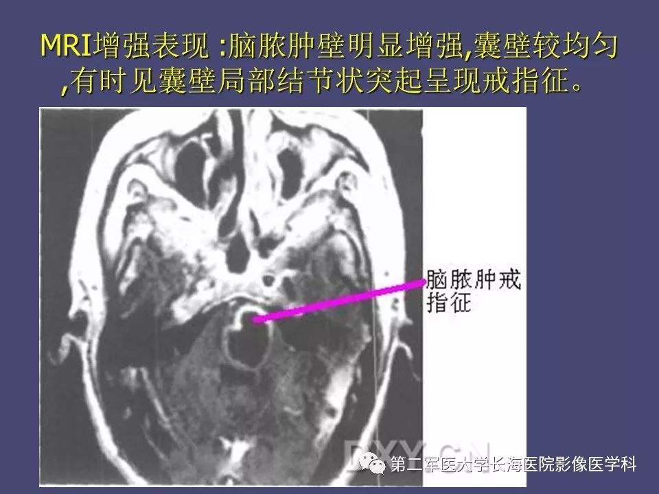 影像PPT - 【PPT】脑内常见环形强化病变的鉴别诊断-26