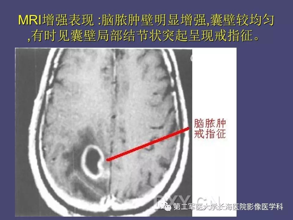 影像PPT - 【PPT】脑内常见环形强化病变的鉴别诊断-27