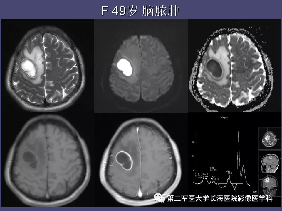 影像PPT - 【PPT】脑内常见环形强化病变的鉴别诊断-29