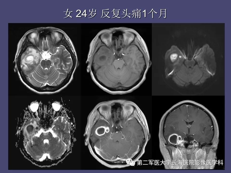 影像PPT - 【PPT】脑内常见环形强化病变的鉴别诊断-30