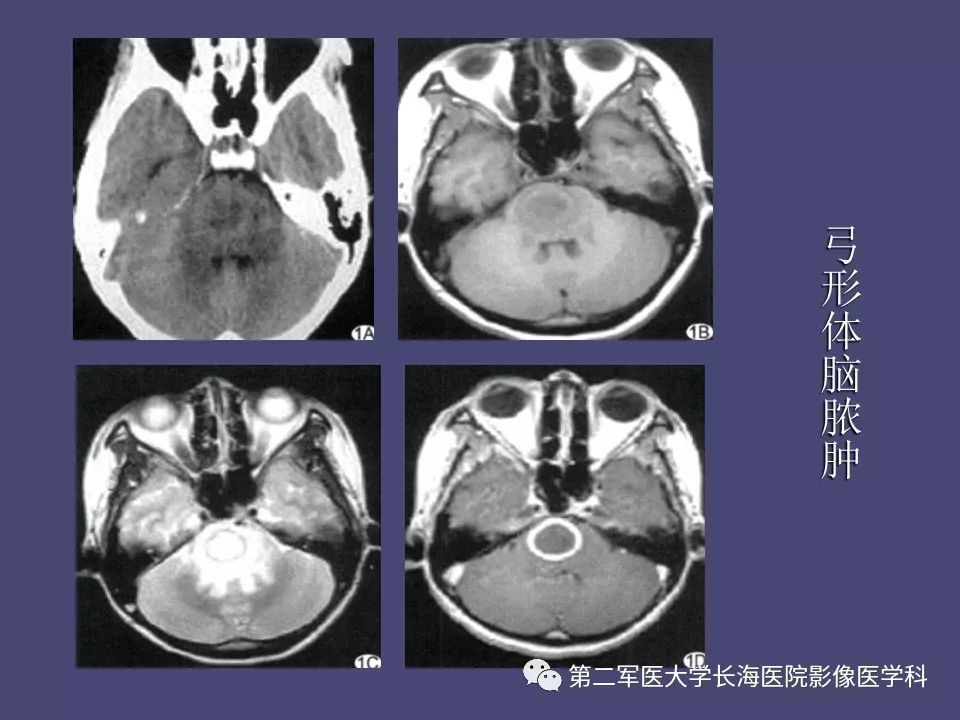 影像PPT - 【PPT】脑内常见环形强化病变的鉴别诊断-35