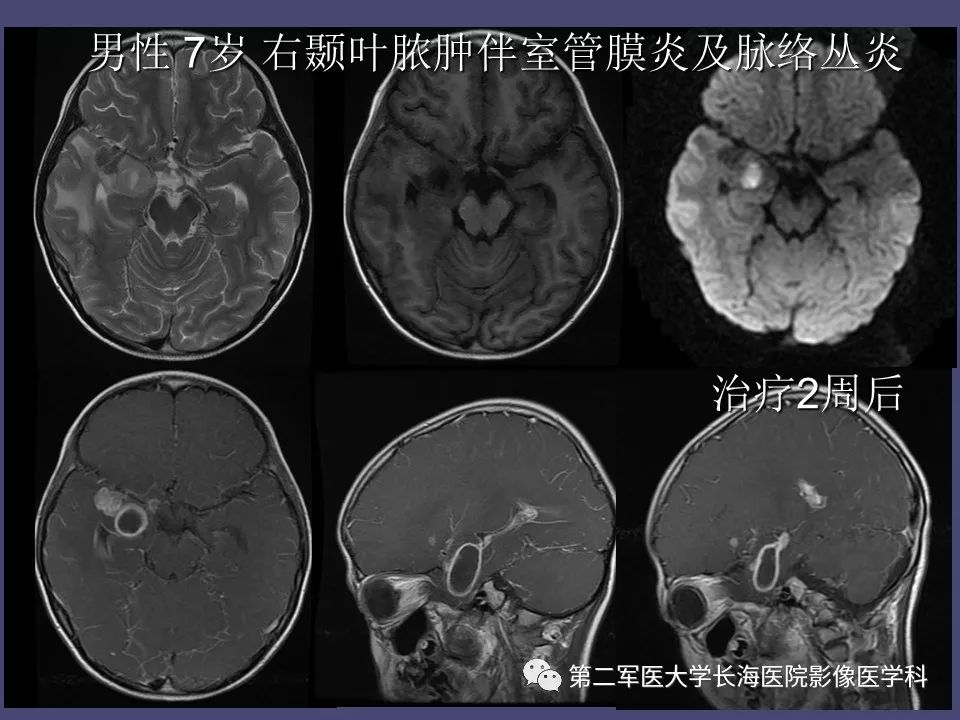 影像PPT - 【PPT】脑内常见环形强化病变的鉴别诊断-31