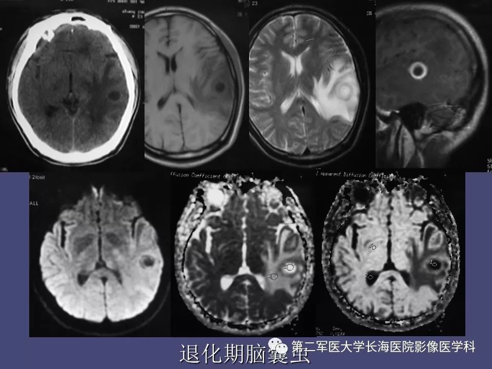 影像PPT - 【PPT】脑内常见环形强化病变的鉴别诊断-36