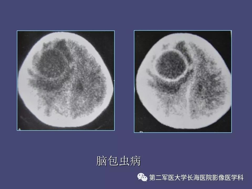 影像PPT - 【PPT】脑内常见环形强化病变的鉴别诊断-37