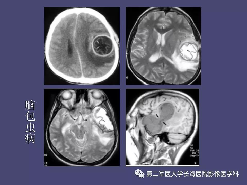 影像PPT - 【PPT】脑内常见环形强化病变的鉴别诊断-38