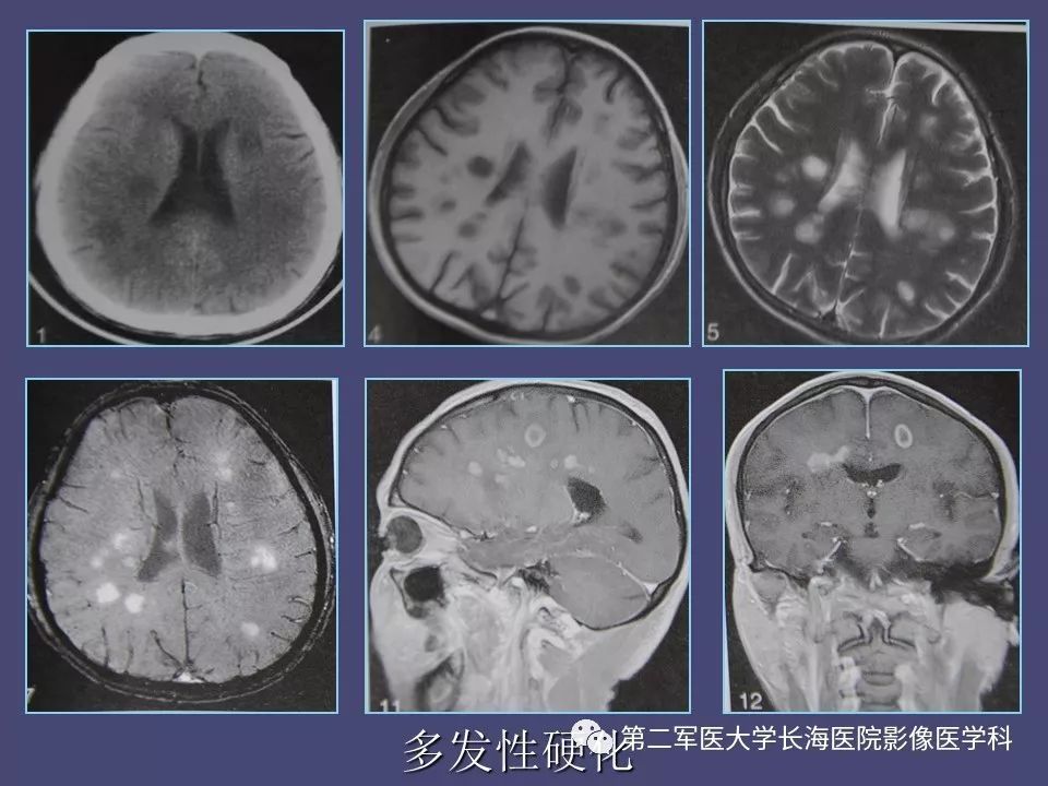 影像PPT - 【PPT】脑内常见环形强化病变的鉴别诊断-41