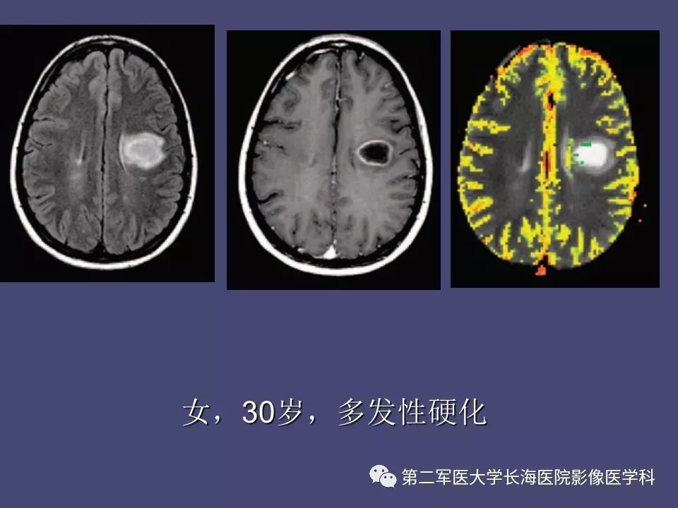 影像PPT - 【PPT】脑内常见环形强化病变的鉴别诊断-42